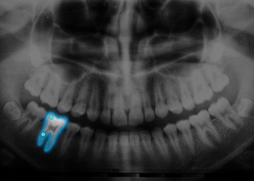 Dental X-Ray interactive segmentation