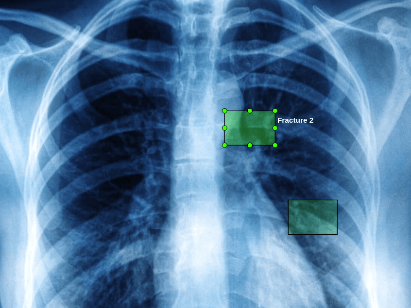 Medical Image annotation tool screenshot - X-Ray