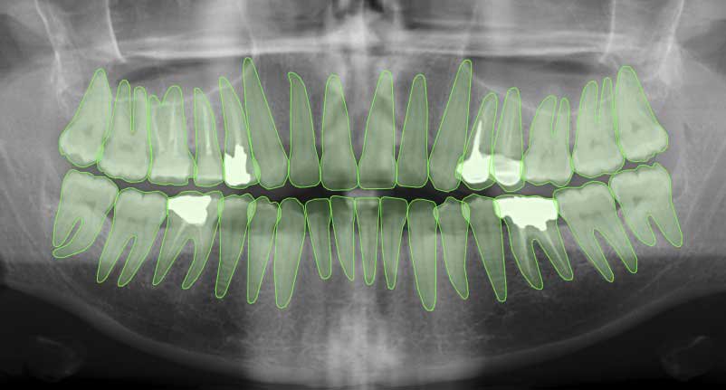 dental-xray-semantic-segmentation